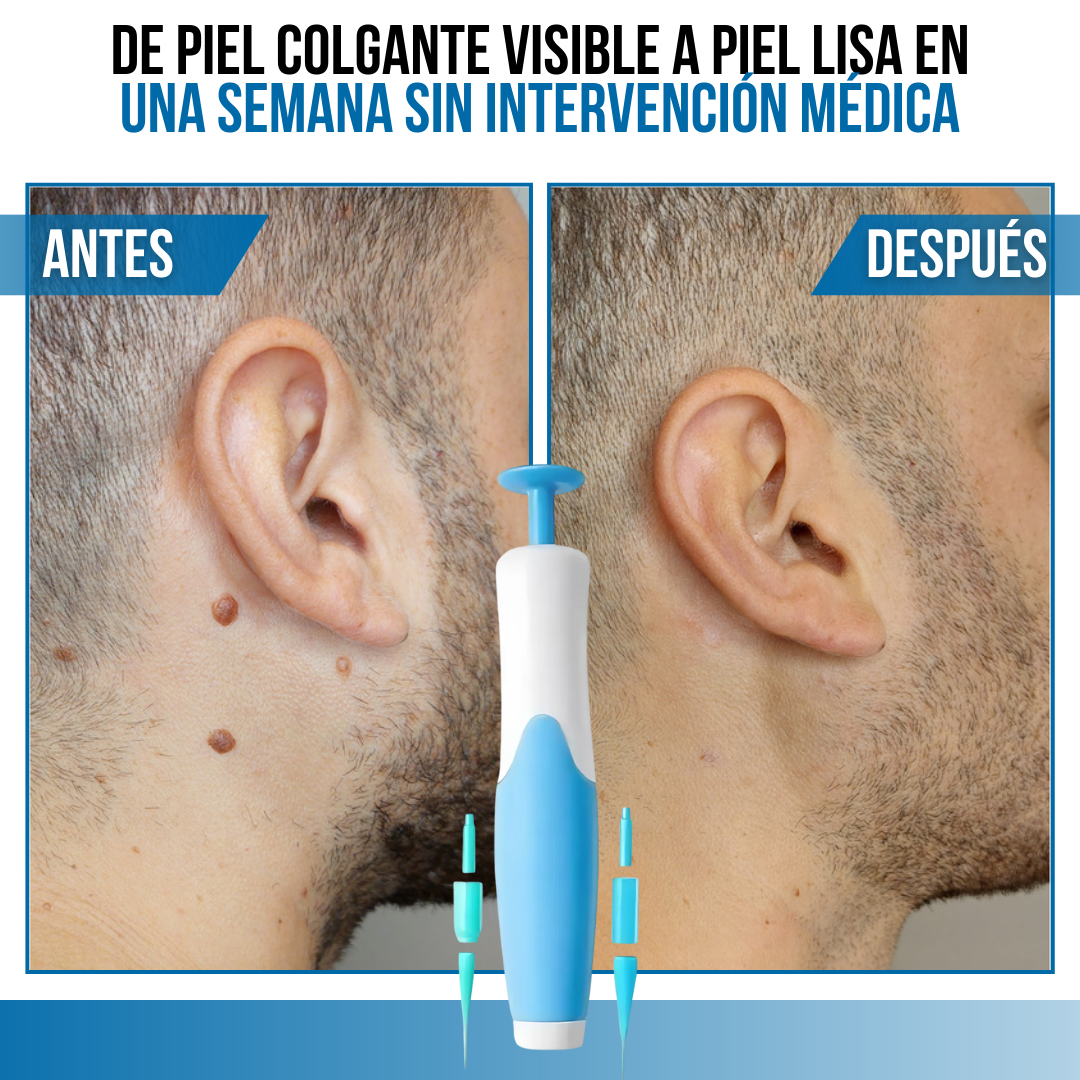 ClearBand™ - Elimina verrugas de forma natural y sin dolor