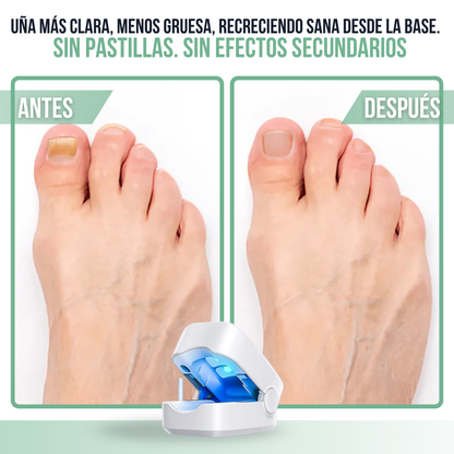 OrthoVital™ | Dispositivo de Luz Azul para Hongos en Uñas