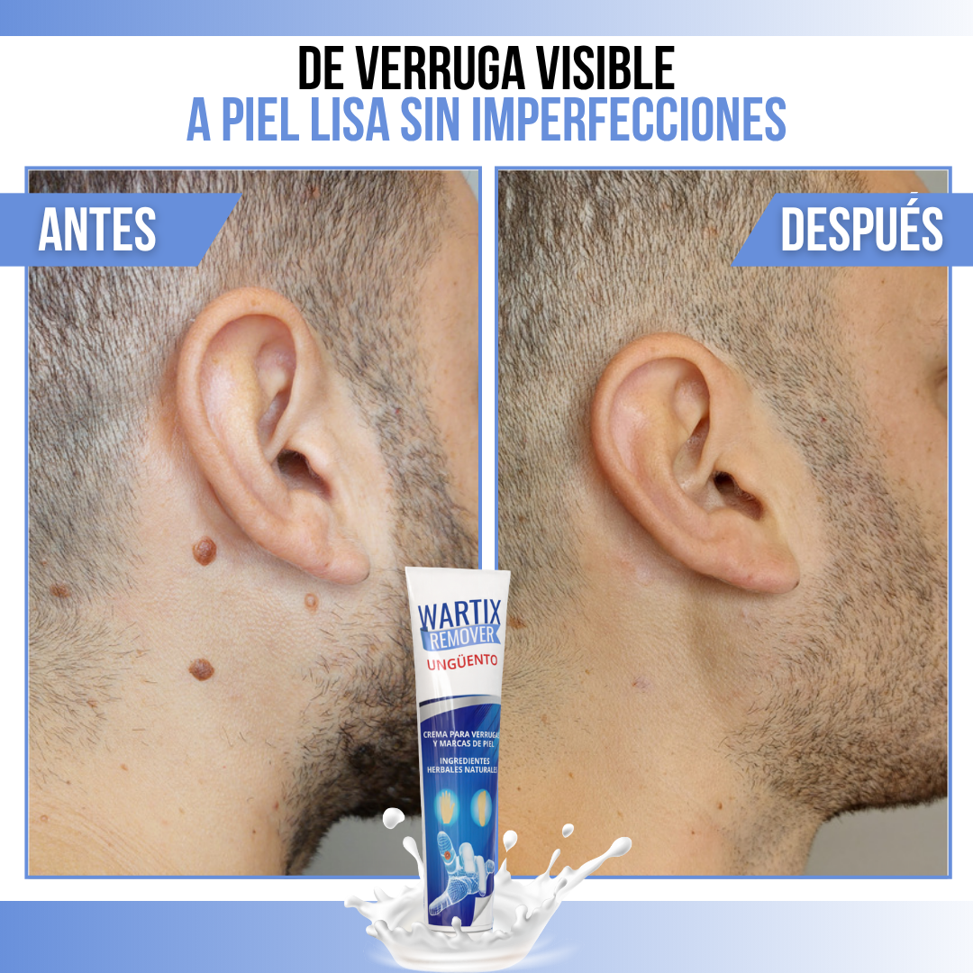 WARTIX REMOVER™ - Elimina verrugas y lunares con suavidad y rapidez